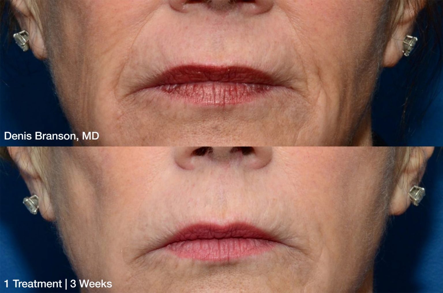 Denis Branson ThermiSmooth Face Mouth 1 treatment 3 weeks Patient 2 1536x1018 1
