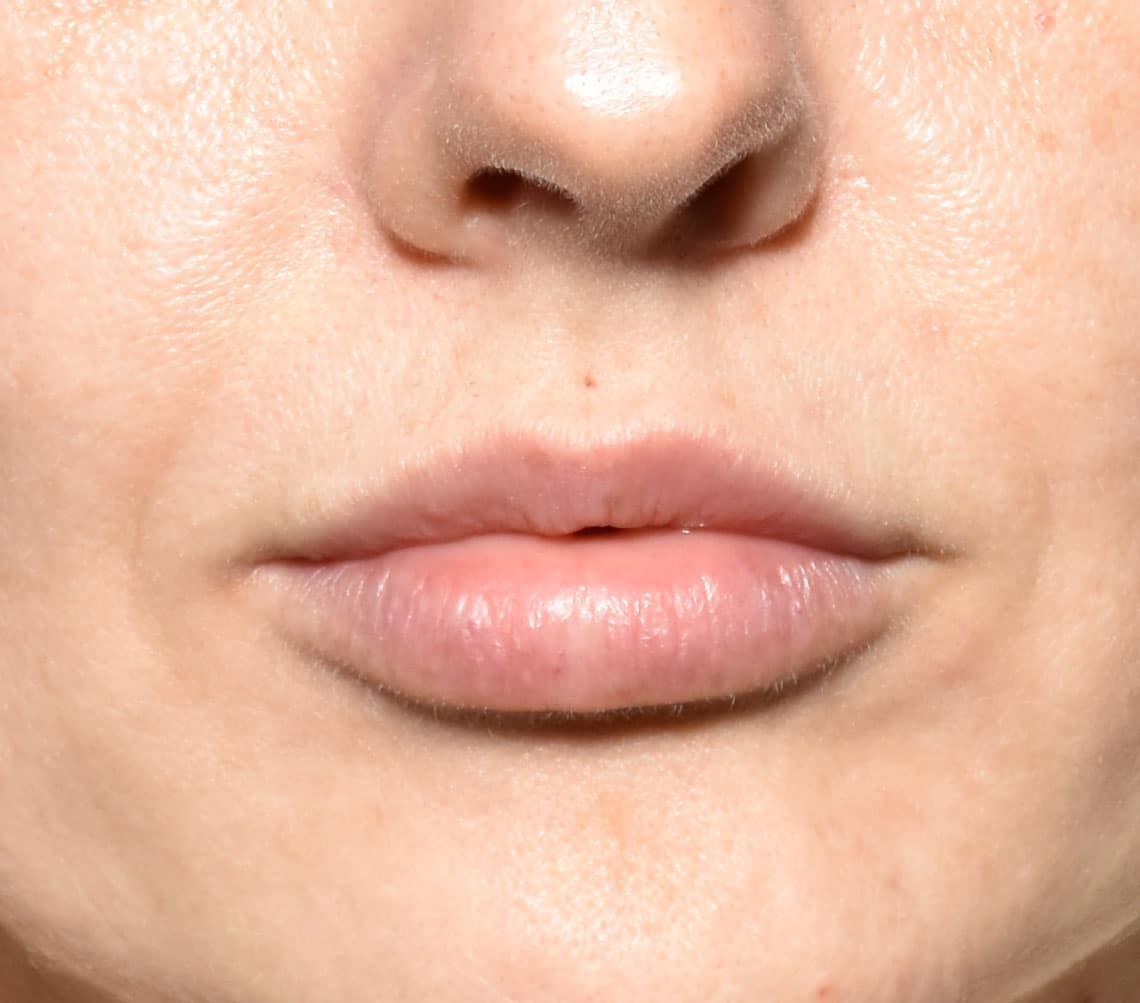 patient’s lips after fillers, more plump after treatment
