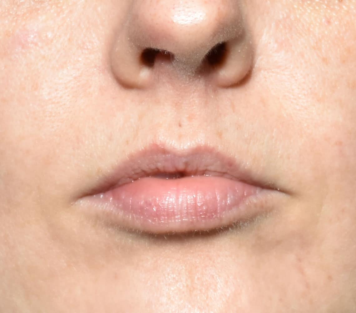 patient’s lips before fillers