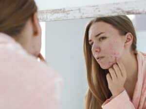 woman with acne problem near mirror in bathroom 1